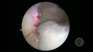 KNEE ARTHROSCOPIC AND SYNOVIAL PLICA [upl. by Bala188]