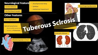 Tuberous Sclerosis  Pathology amp Clinical Features WITH PHOTOS [upl. by Eisenstark495]