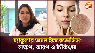 ম্যাকুলার অ্যামাইলয়েডোসিস লক্ষণ কারণ ও চিকিৎসা  Macular Amyloidosis  Channel 24 [upl. by Teevens969]