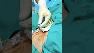 central line insertion steps femoral line insertion procedure central line kaise dalte hain [upl. by Emeric491]