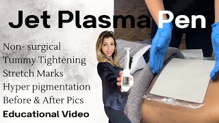 Jet Plasma Treatment Tummy Tightening Pigmentation Stretchmarks with no downtime [upl. by Milena749]