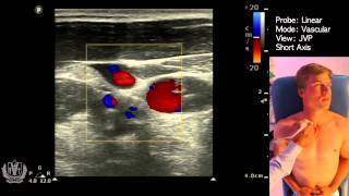 JVP Jugular Venous Pulsation Evaluation using Ultrasound [upl. by Yeltrab771]