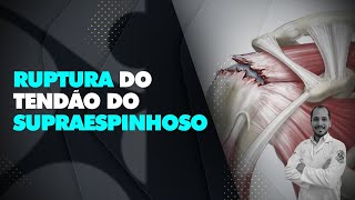 Ruptura do tendão do supraespinhoso [upl. by Brittnee]