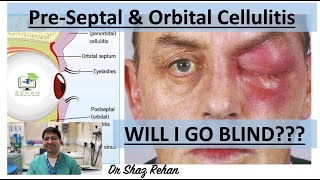 Cellulitis Learn All About PreSeptal amp Orbital Cellulitis I Dr Shaz Rehan 2023 [upl. by Annawik]