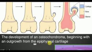 ORTHOPEDICS LECTURES  Tumors  OSTEOCHONDROMA [upl. by Chessy]