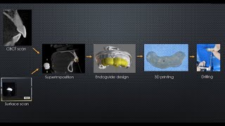 Guided Endodontics Video Demonstration of Complete Clinical Technique [upl. by Llertnauq652]