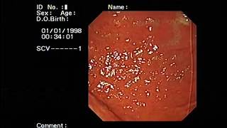 Red spots in the fundus of the stomach [upl. by Karine188]