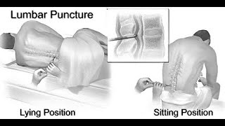 Mnemonics to remember structures pierced during Lumbar Puncture [upl. by Nosreffej313]