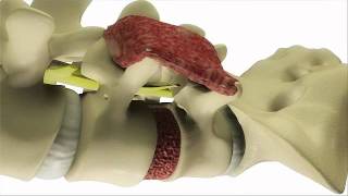 Transforaminal Lumbar Interbody Fusion TLIF Surgery  DePuy Back ampSpine [upl. by Pape]