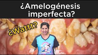 Amelogénesis imperfecta [upl. by Dodie198]