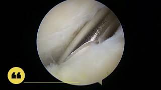 Arthroscopic Excision of Baker Cyst of the Knee via PosteroMedial Portal [upl. by Hewart]