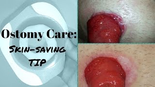 Ostomy care Healing the Skin around the Stoma [upl. by Matazzoni]