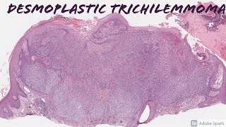 Desmoplastic Trichilemmoma 101 [upl. by Madanhoj]