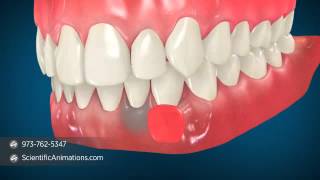 Gum Grafting Surgery  Dental Animation [upl. by Renita]