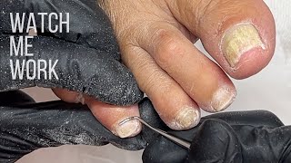 Gentle salon pedicure for mature feet Involuted nails cut too short Watch Me Work [upl. by Cryan569]