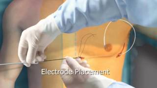 Subcutaneous ICD Animation  Arrhythmiaorg [upl. by Ronyam]