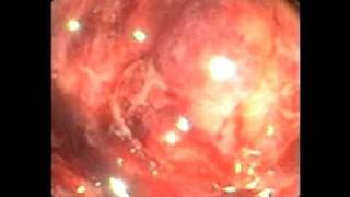 Endoscopy Master Videos ERCP metal stent in a metal stent  wwwgastrolivercomsg [upl. by Clercq]