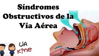 Síndromes Obstructivos de las vías aéreas [upl. by Notsirb186]