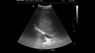 CASE 1116 HEPATOCELLULAR CARCINOMA HCC [upl. by Tuttle]