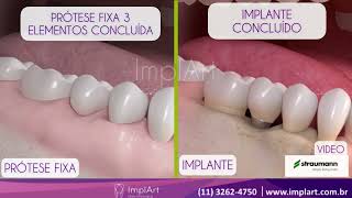 DIFERENÇAS ENTRE IMPLANTE DENTÁRIO E PRÓTESE FIXA ImplArtImplanteseestetica [upl. by Ordnael]