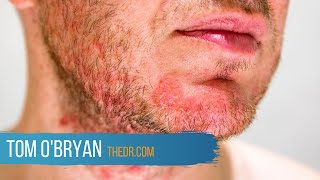 Dermatitis Herpetiformis A GlutenRelated Disorder  Dr Tom OBryan [upl. by Maxa]