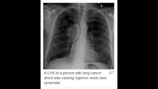 Superior Vena Cava Syndrome [upl. by Paine414]