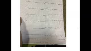 peripartum cardiomyopathy Grand round [upl. by Ayotas869]