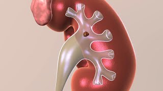 Kidney Stone Treatments [upl. by Nolak]