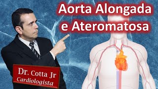 Aorta Alongada e Ateromatosa o que é quais as causas e tratamento [upl. by Rimidalg]