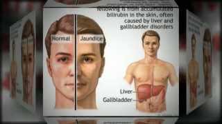 Cirrhosis Of The Liver Information [upl. by Siraf]