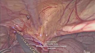 Laparoscopic Herniotomy in a Child [upl. by Shandra]