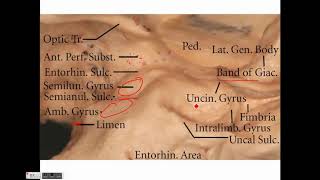 Neurosurgery Temporal lobe anatomy and its implications in temporal lobe epilepsy [upl. by Aittam277]