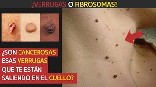 ¿Son cancerosas esas verrugas que te están saliendo en el cuello [upl. by Alleuqram]