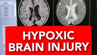 MRI of Hypoxic Ischaemic Brain Injury 10months Child shorts shortsvideo shortsvideos [upl. by Eseela]