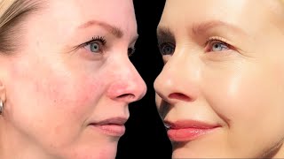 AZELAIC ACID  how to layer in your routine  it FIXED my ROSACEA [upl. by Notrab]