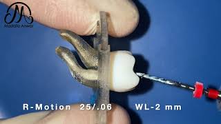 RMotion Reciprocating Sequence for Management of S Shaped Root Canal Educational Demo Video [upl. by Arreit]