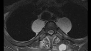 Neurofibromatosis [upl. by Cerf]