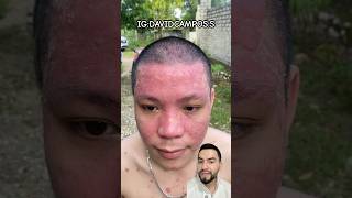 PSORIASIS EN EL ROSTRO [upl. by Ydnew986]