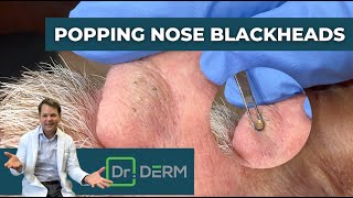 Popping Nose Blackheads  Dr Derm [upl. by Venice]