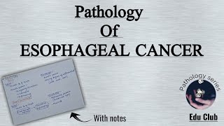 Esophageal Cancer  Adenocarcinoma  Squamous cell carcinoma  GIT Pathology [upl. by Eisyak19]