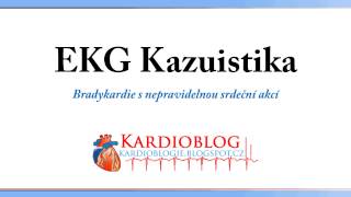 Kardioblog  EKG Kazuistika Bradykardie s nepravidelnou srdeční akcí [upl. by September]