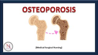 OSTEOPOROSIS  Causes  Pathophysiology  Treatment  Nursing Management  The Nurses Station [upl. by Prosser429]