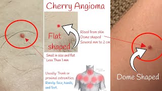 Cherry angioma  Red moles on skin [upl. by Heyman533]