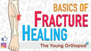 Fracture Healing  ANIMATION  BASICS  The Young Orthopod [upl. by Mulac]