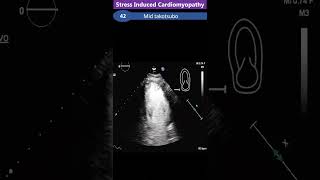 Takotsubo Stress Induced  Cardiomyopathy [upl. by Adnirim]