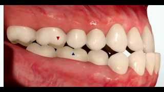 Class III Malocclusion [upl. by Necila]