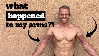 What happened to my arms Graston Technique to get my range of motion back [upl. by Frear]