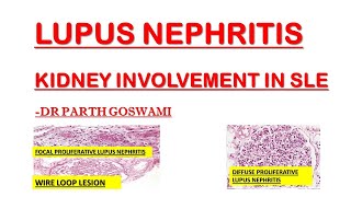 Lupus Nephritis  Wire Loop Lesion [upl. by Valerio]