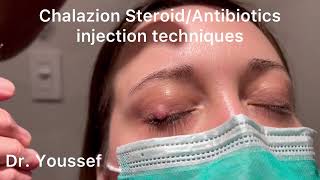 Chalazion Easiest and simplest Treatment with Steroid and Antibiotic Injections [upl. by Menides]