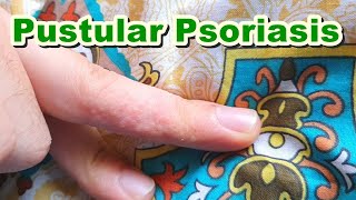 Pompholyx of Pustular Psoriasis  Topical Corticosteroids amp Antibiotics  Betamethasone  Gentamicin [upl. by Gnirps]